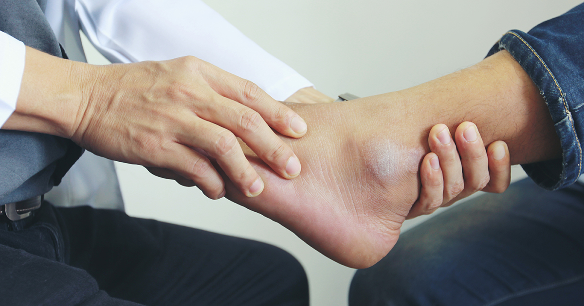 Broken (fractured) ankles: FAQs answered by a specialist